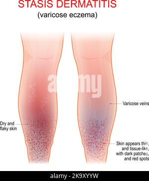 Eczema varicoso. Sintomi di dermatite venosa, gravitazionale o stasi. Condizione della pelle a lungo termine che colpisce le gambe inferiori con vene varicose Illustrazione Vettoriale