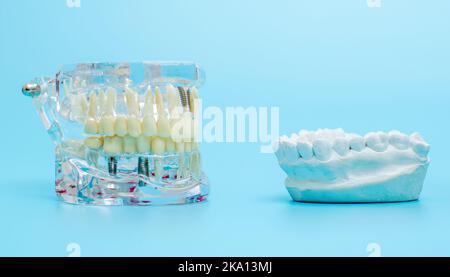 Confrontare il modello di dente e il modello di dente con il filo metallico dentale Foto Stock