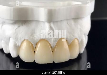 Corone di Zirconia con tutte le porcellane cotte al forno. Corone dentali per la mandibola superiore su un modello. Laboratorio protesico dentale. Foto Stock