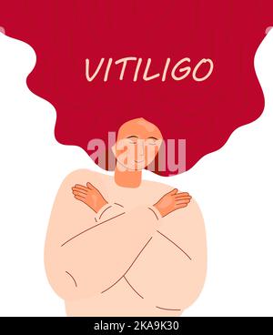 Vettore di concetto Vitiligo per il web, app. Illustrazione di giorno di vitiligine del mondo. Malattia della pelle e problemi dermatologici. Illustrazione Vettoriale