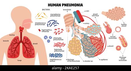 Polmonite umana composizione con icone di batteri infettivi polmoni umani parti e didascalie di testo con puntatori vettore illustrazione Illustrazione Vettoriale