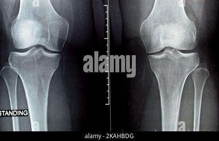 Radiografia semplice sull'articolazione del ginocchio che mostra restringimento dello spazio articolare e sclerosi subcondrale sul compartimento mediale (ispessimento dell'osso che avviene nella pula articolare Foto Stock