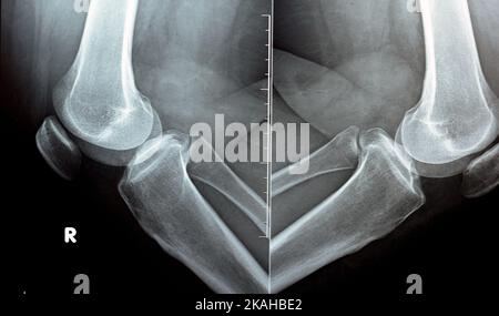 Radiografia semplice sull'articolazione del ginocchio che mostra restringimento dello spazio articolare e sclerosi subcondrale sul compartimento mediale (ispessimento dell'osso che avviene nella pula articolare Foto Stock