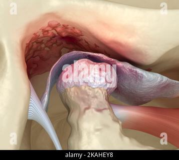 Artrite delle articolazioni temporomandibolari e disco articolare dislocato. Illustrazione 3D accurata dal punto di vista medico. Foto Stock