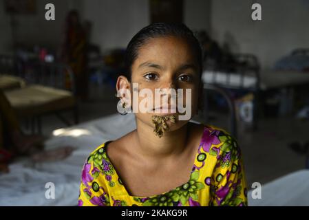 In questa fotografia scattata il 30 gennaio 2017, il paziente del Bangladesh Sahana Khatun, 10 anni, posa per una fotografia al Dhaka Medical College and Hospital. Una giovane ragazza del Bangladesh con verruche simili alla corteccia che crescono sul suo viso potrebbe essere la prima donna mai afflitta dalla cosiddetta 'sindrome dell'uomo dell'albero', i medici che studiano la rara condizione ha detto il 31 gennaio. Sahana Khatun, di dieci anni, ha la storia gnarled crescite germogliate dal mento, dall'orecchio e dal naso, ma i medici del Dhaka's Medical College Hospital stanno ancora conducendo test per stabilire se ha il disturbo insolito della pelle. (Foto di Mamunur Rashid/NurP Foto Stock