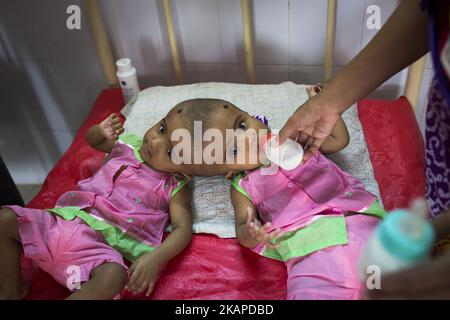 Le ragazze gemelle Rabeya Islam e Rokeya Islam bevono latte in un ospedale a Dhaka, Bangladesh, il 29 luglio 2017. Taslima Khatun, insegnante di scuola, ha dato alla luce i gemelli a testa riunita il 16 luglio 2016 dopo un cesareo. I gemelli sono stati ricoverati in un ospedale governativo per un esame prima di un eventuale intervento chirurgico per separare la testa. (Foto di Zakir Hossain Chowdhury/NurPhoto) *** Please use Credit from Credit Field *** Foto Stock