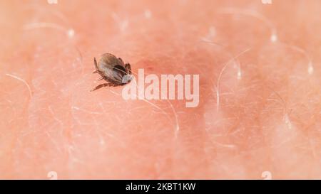 Zecca parassita di cervo morso nella pelle umana a succhiare il sangue. Ixodes ricino o scapularis. Closeup di acaro di insetto pericoloso sullo sfondo di epidermide rosa. Foto Stock