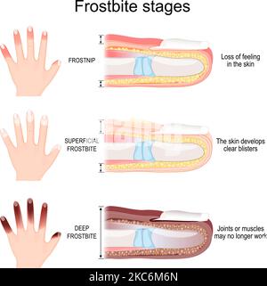 Frostbite stages of fingers. From Frostnip with Loss of feeling in the skin to Deep Frostbite of Joints and muscles. Vector illustration Stock Vector