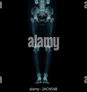 CT scan of Lower extremity ,3D Illustration of Femur bone , knee joint , leg and foot . Foto Stock