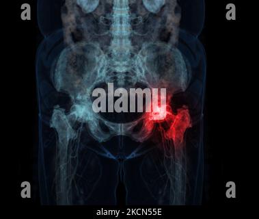 3D che rende osso pelvico e articolazione dell'anca 3D isolato su sfondo nero. Foto Stock