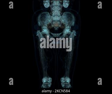 CT scan of Lower extremity ,3D Illustration of Femur bone , knee joint , leg and foot . Foto Stock