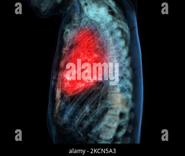 Cuore umano dolore di attacco come una anatomia medica nozione di malattia con una persona che soffre di una malattia cardiaca come un doloroso evento coronarico con 3D illus Foto Stock