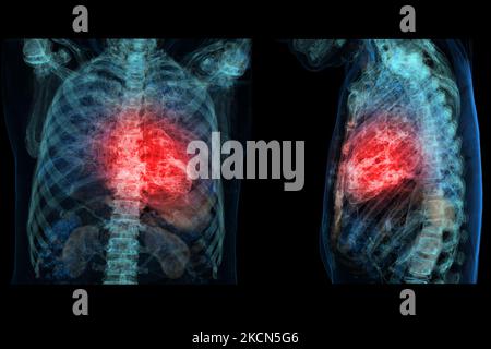 Cuore umano dolore di attacco come una anatomia medica nozione di malattia con una persona che soffre di una malattia cardiaca come un doloroso evento coronarico con 3D illus Foto Stock