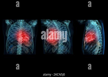 Cuore umano dolore di attacco come una anatomia medica nozione di malattia con una persona che soffre di una malattia cardiaca come un doloroso evento coronarico con 3D illus Foto Stock