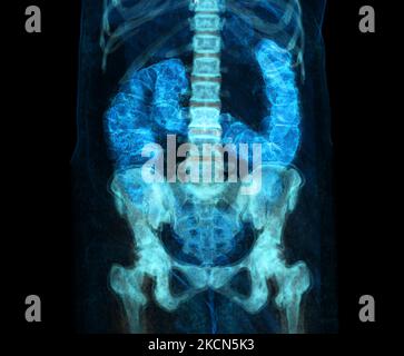 Colonografia TC o scansione TC dell'immagine di rappresentazione Colon 3D per lo screening del cancro colorettale. Controllare Screening Colon Cancer. Foto Stock