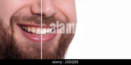 Cura dentale e sbiancamento dei denti confrontare, uomo prima e dopo sbiancamento isolato su sfondo bianco, immagine panoramica Foto Stock