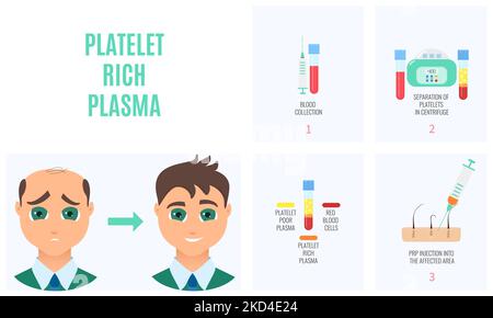 Trattamento di perdita dei capelli di PRP, illustrazione concettuale Foto Stock