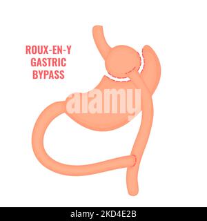 Roux-en-y gastrico bypass chirurgia bariatrica, illustrazione Foto Stock