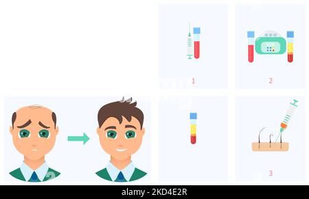 Trattamento di perdita dei capelli di PRP, illustrazione concettuale Foto Stock
