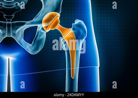 Illustrazione del rendering a raggi X 3D della protesi dell'anca. Intervento chirurgico di sostituzione totale dell'articolazione dell'anca o artroplastica, medico e sanitario, artrite, patologia, sci Foto Stock