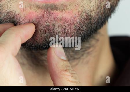 Dermatite seborroica nella barba. Eczema sul viso maschile primo piano. Foto Stock