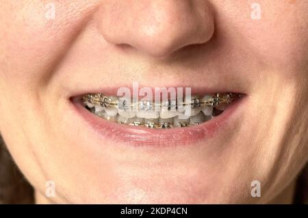 un sorriso di donna con denti aperti su cui ci sono sostegni Foto Stock