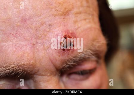 Carcinoma a cellule squamose sulla fronte di una donna anziana Foto Stock