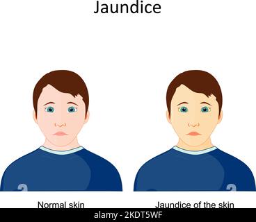 Ittero. Segni e sintomi della malattia confronto e differenze tra uomo sano e persona con pigmentazione giallastra della pelle e sclera. Illustrazione Vettoriale