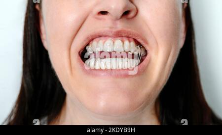 Donna a bocca aperta con trattamento ortodontico con allineatori trasparenti rimovibili Foto Stock