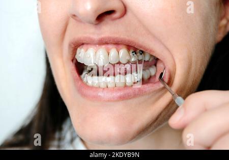 Donna a bocca aperta con bottoni dentali e fascia elastica per il trattamento ortodontico Foto Stock