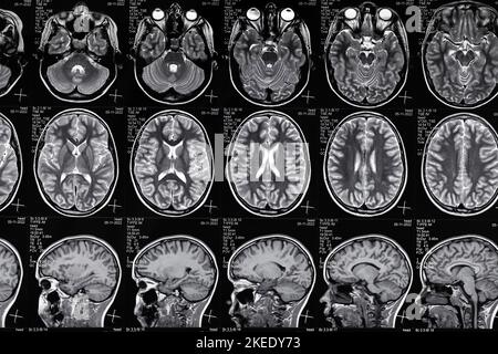 Scansione ad alta risoluzione dell'immagine di risonanza magnetica della sindrome dell'epi cerebrale. Scansione RM reale della testa, primo piano. Foto Stock