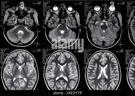 Scansione ad alta risoluzione dell'immagine di risonanza magnetica della sindrome dell'epi cerebrale. Scansione RM reale della testa, primo piano. Foto Stock