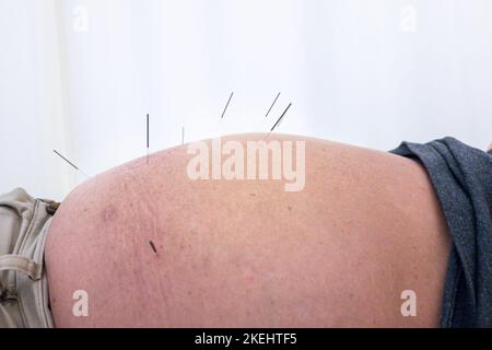 Primo piano dell'uomo asiatico che riceve un trattamento di agopuntura sulla pancia sporgente grande Foto Stock