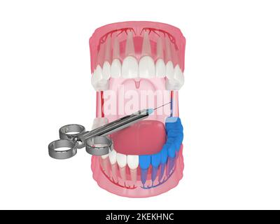 3d rappresentazione della mandibola umana con tecnica di blocco del nervo alveolare inferiore. Concetto di tecniche di anestesia dentale. Foto Stock