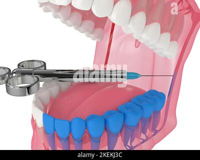 3d rappresentazione della mandibola umana con tecnica di blocco del nervo alveolare inferiore. Concetto di tecniche di anestesia dentale. Foto Stock