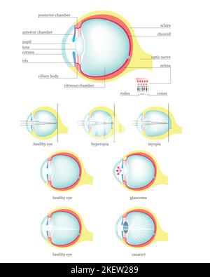 Diagramma medico della sezione trasversale dell'anatomia dell'occhio umano, illustrazione con isolamento piatto vettoriale. Struttura dell'occhio sano e con glaucoma, cataratta, iperopia, m Illustrazione Vettoriale