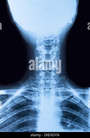 Immagine radiografica del collo superiore della colonna cervicale di un uomo Foto Stock