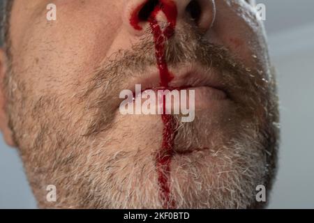 Sanguinamenti di naso , UN uomo sta sanguinando dal naso Foto Stock