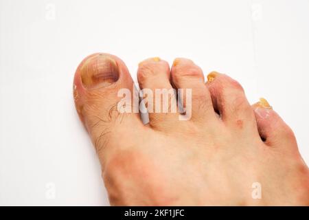 Primo piano fungo sulle unghie del piede di un uomo su uno sfondo bianco Foto Stock