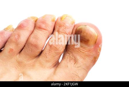 Primo piano fungo sulle unghie del piede di un uomo su uno sfondo bianco Foto Stock