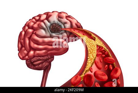 Demenza vascolare e necrosi da liquefazione cerebrale dovuta a perdita di circolazione sanguigna alla mente dopo un ictus causato da ostruzione arteriosa risultante Foto Stock