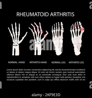 ARTRITE GAMBA MANO reumatoide malattia cronica diagramma di educazione Medicina Schema vettoriale mano umana disegnata Vector Illustration Illustrazione Vettoriale