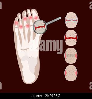 ARTRITE GAMBA malattia cronica reumatoide Medicina diagramma di educazione Schema vettoriale umano mano disegnata vettore Illustrazione Set Illustrazione Vettoriale