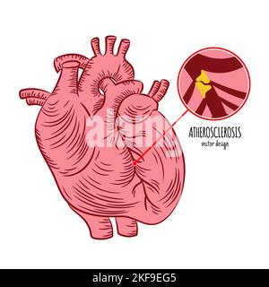 ATEROSCLEROSI malattia cronica Medicina diagramma di educazione Schema vettoriale umano mano disegnata Vector Illustration Illustrazione Vettoriale