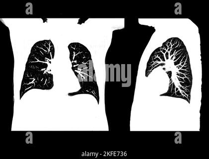 Scansione TC del torace o del polmone presso il reparto di radiologia dell'ospedale. Covid-19 scan body xray test detection for covid virus epidemic spread concept Foto Stock