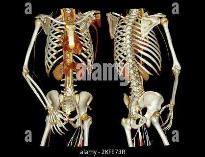 Immagine di rendering dell'aorta intera e dell'arteria brachiale 3D CTA nel caso in cui il paziente sia traatico. Foto Stock