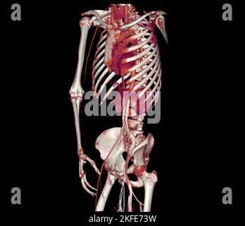 Immagine di rendering dell'aorta intera e dell'arteria brachiale 3D CTA nel caso in cui il paziente sia traatico. Foto Stock