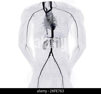 Immagine di rendering dell'aorta intera e dell'arteria brachiale 3D CTA nel caso in cui il paziente sia traatico. Foto Stock