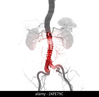 CTA aorta intera con innesto di stent aorta addominale confrontare l'immagine di rappresentazione 3D nel caso di aneurismi aortici addominali. Foto Stock