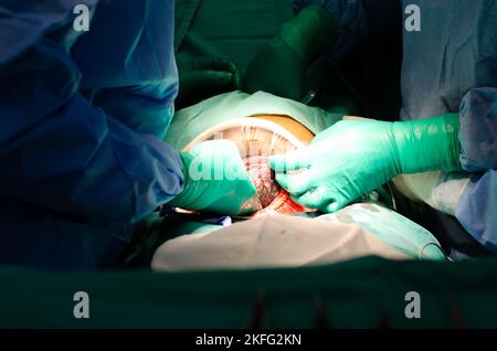 Sezione Cesarean, primo piano del bambino che viene rimosso dal grembo materno durante l'intervento chirurgico Foto Stock